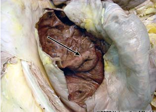 <p>what structure in the large intestine is this (be specfic)?</p>