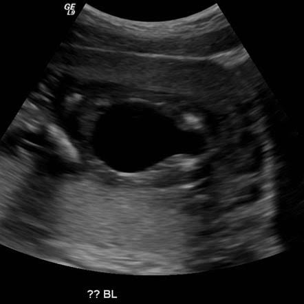 <p>urine unable to pass through urethra due to membrane within posterior urethra</p><ul><li><p>happens in males </p></li><li><p>overdistended bladder— key hole sign</p></li></ul><p></p>
