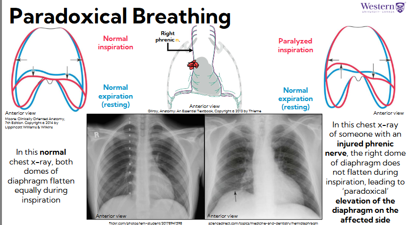 <ul><li><p>abnormal breathing pattern where the chest contracts while abdomen rises during inhalation </p></li><li><p>happens due to injured phrenic nerve </p></li><li><p>elevation of the diaphragm on the affected side </p></li></ul><p></p>