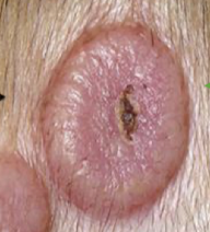 <p>What primary lesion is this? (>1 cm)</p>