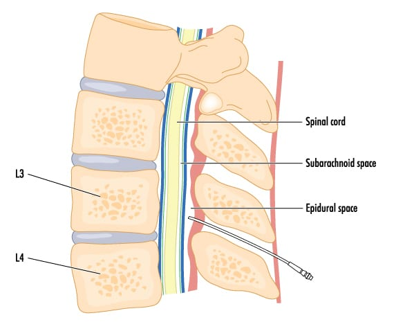 <ol><li><p>spinal anesthesia is when local anesthesia is injected into the subarachnoid space mixing with CSF to block nerve conduction</p></li><li><p>typically last 4-8 hours depending on the meds and dosage </p></li><li><p>adverse effects: high spinal block (when local anesthetic spreads above the T4 causing severe cardiovascular, respiratory, and neurological effects like severe hypotension, bradycardia, and respiratory depression), post-spinal headache, N, V</p></li></ol><p></p>