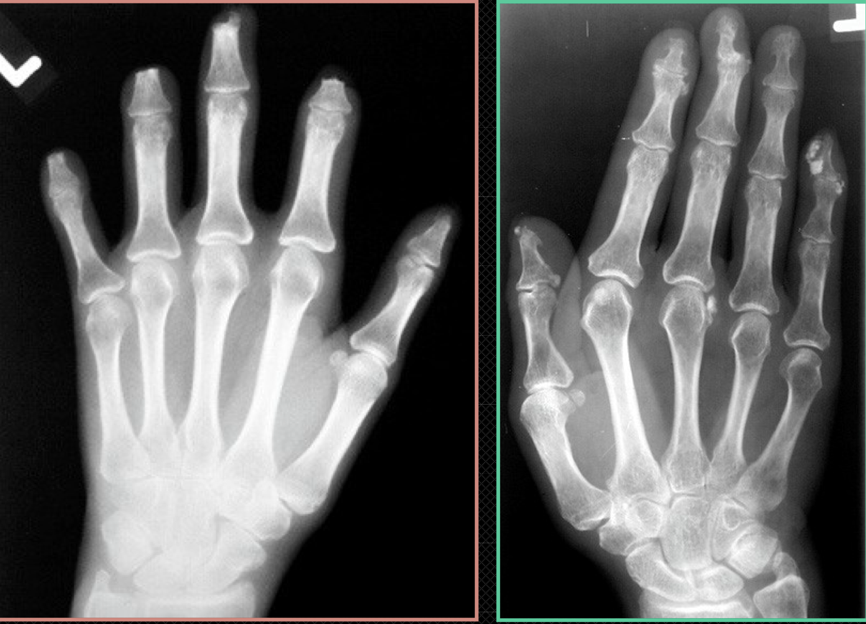 <p>How to differentiate scleroderma from other causes</p>