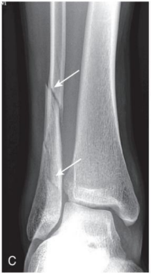 <p>direction of fracture line</p>