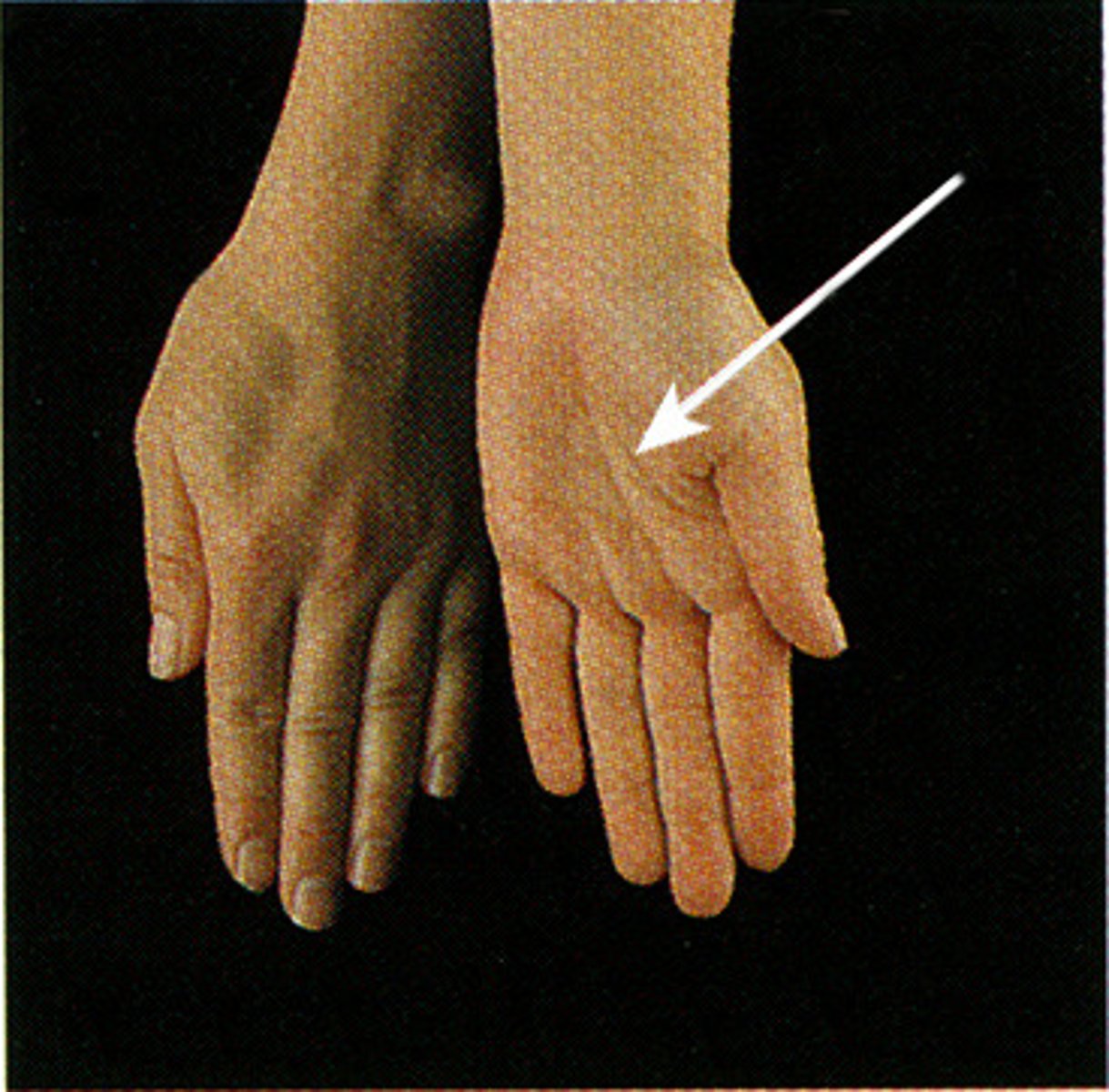 <p>Rotating the forearm so the palm faces anteriorly.</p><p>Example: Occurs when the forearm, specifically the radius, rotates laterally so that the palm faces anteriorly.</p>
