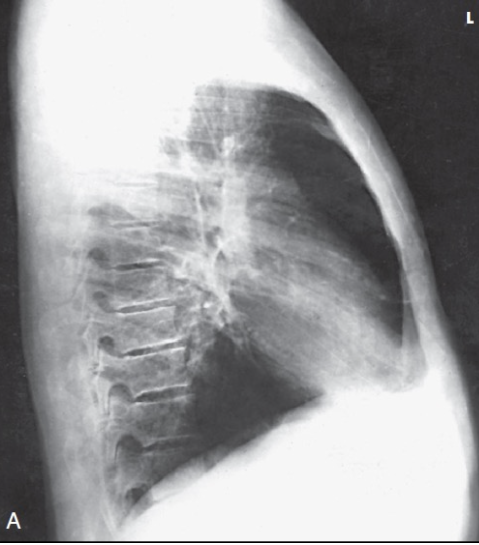 <ul><li><p><strong>Costophrenic angles</strong></p></li><li><p><strong>Lower lung apices</strong></p></li><li><p><strong>Hilum centered</strong> and <strong>sternum in profile</strong>.</p></li></ul><p></p>