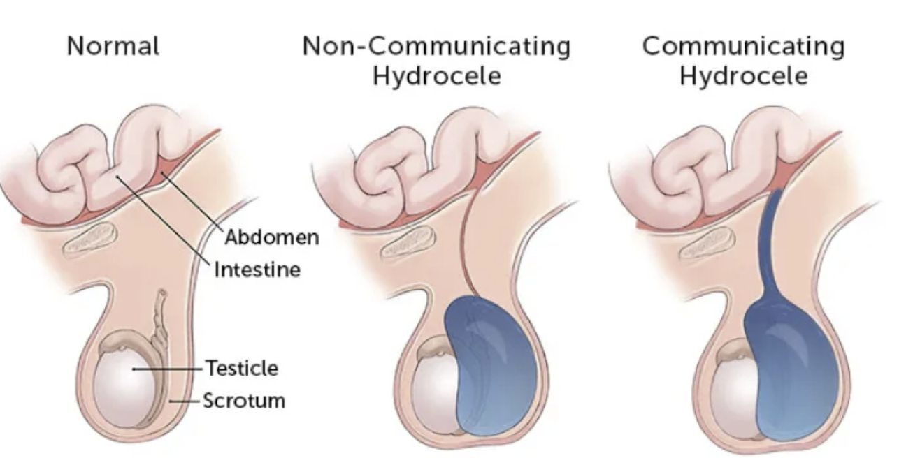 <ul><li><p>communicating = trapped inguinal passageway = swelling, pain, stuck = incarcerated hernia </p><ul><li><p>surgeon pushes stuck content into abdominal cavity for temporary measure, but over time, passageway remains open; need surgery to fix </p></li><li><p>increase risk of<strong> inguinal hernia</strong> - crying can increase this </p></li></ul></li></ul><p></p>