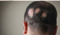<p>Sudden, rapid, coin-shaped loss of hair, usually from the scalp or face</p>