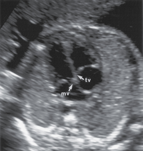 <p>tricuspid valve, </p>
