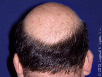 <p>What does this refer to</p><ul><li><p>Male pattern hair loss</p></li><li><p>Slow progressive loss of hair in a characteristic distribution</p></li></ul><p></p>