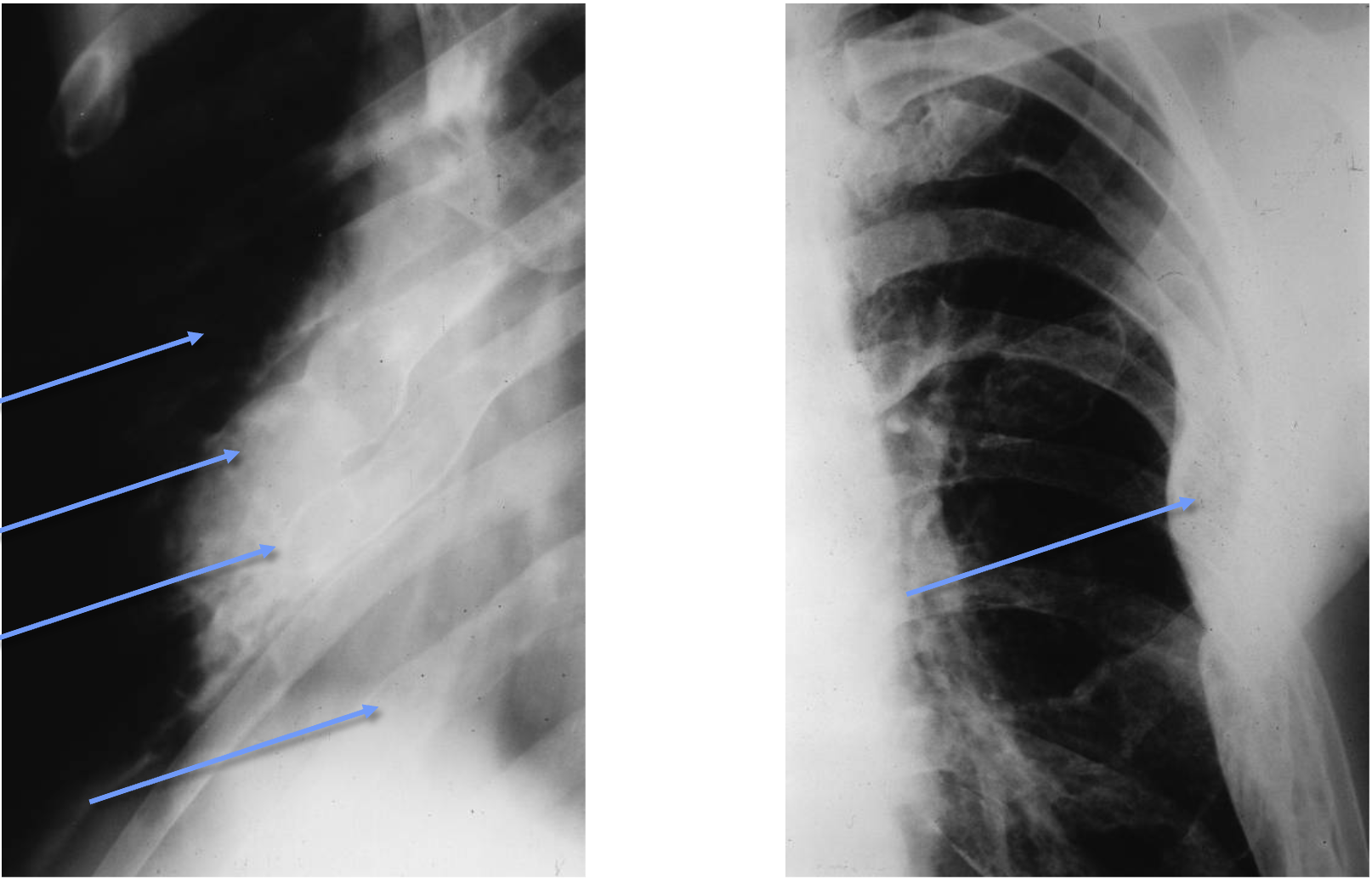<p>What tumour like disorder is this, what can you see?</p>