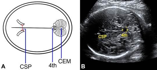 <p>****38. The fourth ventricle is located:</p><p>a. posterior to the CSP.</p><p>b. between the frontal horns of the lateral ventricles.</p><p>c. anterior to the cerebellar vermis.</p><p>d. medial to the third ventricle.</p>
