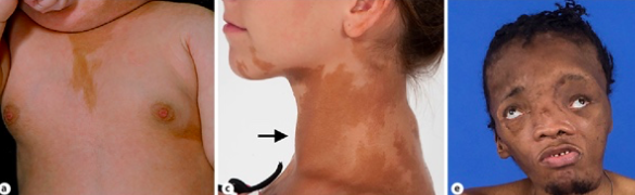 <p>precocious or very early puberty</p><ul><li><p><strong>boys </strong>→ less noticeable symptoms</p></li><li><p><strong>girls</strong> → early puberty with menstrual bleeding before age 2</p></li></ul><p></p>