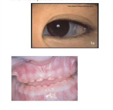 <p>“<strong>brittle</strong> bone disease”</p><ol><li><p><span style="color: rgb(99, 190, 221);">multiple <strong>bone fracture</strong></span></p></li><li><p><span style="color: rgb(60, 79, 210);"><strong>blue </strong>sclera</span></p></li><li><p><span style="color: rgb(187, 34, 183);">early <strong>hearing loss</strong></span></p></li><li><p><span style="color: rgb(151, 124, 43);"><strong>small, discolored teeth</strong></span></p></li></ol><p></p>