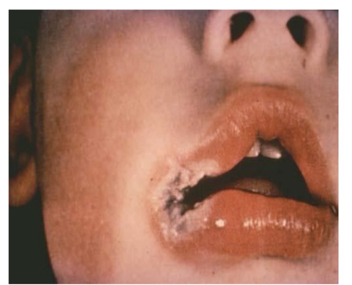 <p>BN 6y</p><p>Vết loét sâu</p><p>CHẨN ĐOÁN?</p>