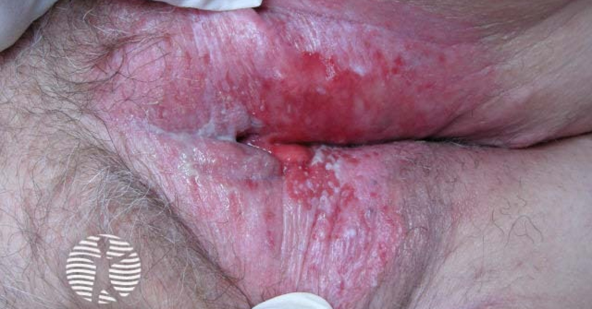 <p>VIN that is a superficial lesion of the epithelium that has not invaded the basement membrane and may progress to carcinoma in situ or SCC</p><p>-Presentation: vulvar pruritis. Well-demarcated, slightly raised, erythematous lesion with an eczematoid appearance </p><p>-Dx: colposcopic biopsy, will have a fiery red background mottled with whitish hyperkeratotic areas. Large pale cells of apocrine origin below the surface of the epithelium </p><p>-Tx: local wide excision </p>