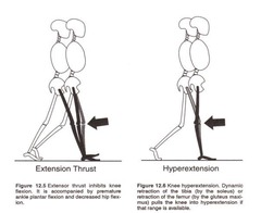 <p>Excessive extension of the knee joint.</p>