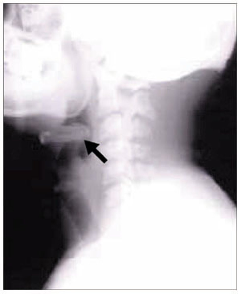 <p>-inflammation of the epiglottis</p><p>-can be fatal in children 2-5</p>