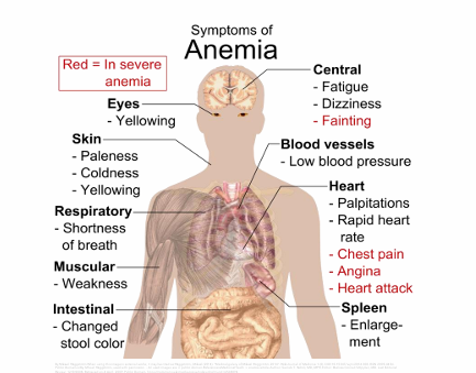 <p>Onset of S/S may be abrupt or insidious</p><ul><li><p>General S/S of anemia due to low RBCs</p></li><li><p>Additional S/S include those to low Plts (bleeding)</p></li><li><p>May also include S/S due to low WBCs</p></li></ul><p></p>