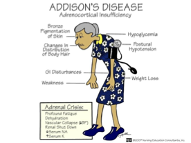 <p><mark data-color="yellow" style="background-color: yellow; color: inherit;">Destruction of adrenal glands → </mark><span style="color: red;"><mark data-color="yellow" style="background-color: yellow; color: inherit;">low hormones (cortisol + aldosterone)</mark></span></p><ul><li><p>mostly females </p></li></ul><p><strong><mark data-color="blue" style="background-color: blue; color: inherit;">Signs:</mark></strong> asymp until <span style="color: green;">90%</span> of adrenal cortex destroyed </p><ul><li><p>hypoglycemia, weight loss, depression, <span style="color: red;">darken bronze hyperpigment.</span>, hyponatremia (salt craving), water loss, hyerK,</p></li></ul><p><strong><mark data-color="red" style="background-color: red; color: inherit;">Diagnostic: </mark></strong>test hypothalamic pituitary axis &amp; adrenal cortex, serum electro</p><p><strong><mark data-color="purple" style="background-color: purple; color: inherit;">Care:</mark></strong></p><ul><li><p>replacement of cortisol, fix electrolyte imbalance, maintain fluids</p></li><li><p>take hormone replace daily </p></li></ul><p></p>
