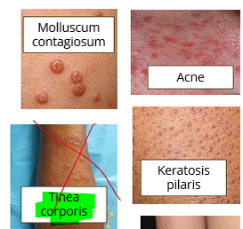 <ul><li><p>Some acne</p></li><li><p>Warts</p></li><li><p> Many viral rashes</p></li><li><p> Keratosis pilaris</p></li></ul><p></p>