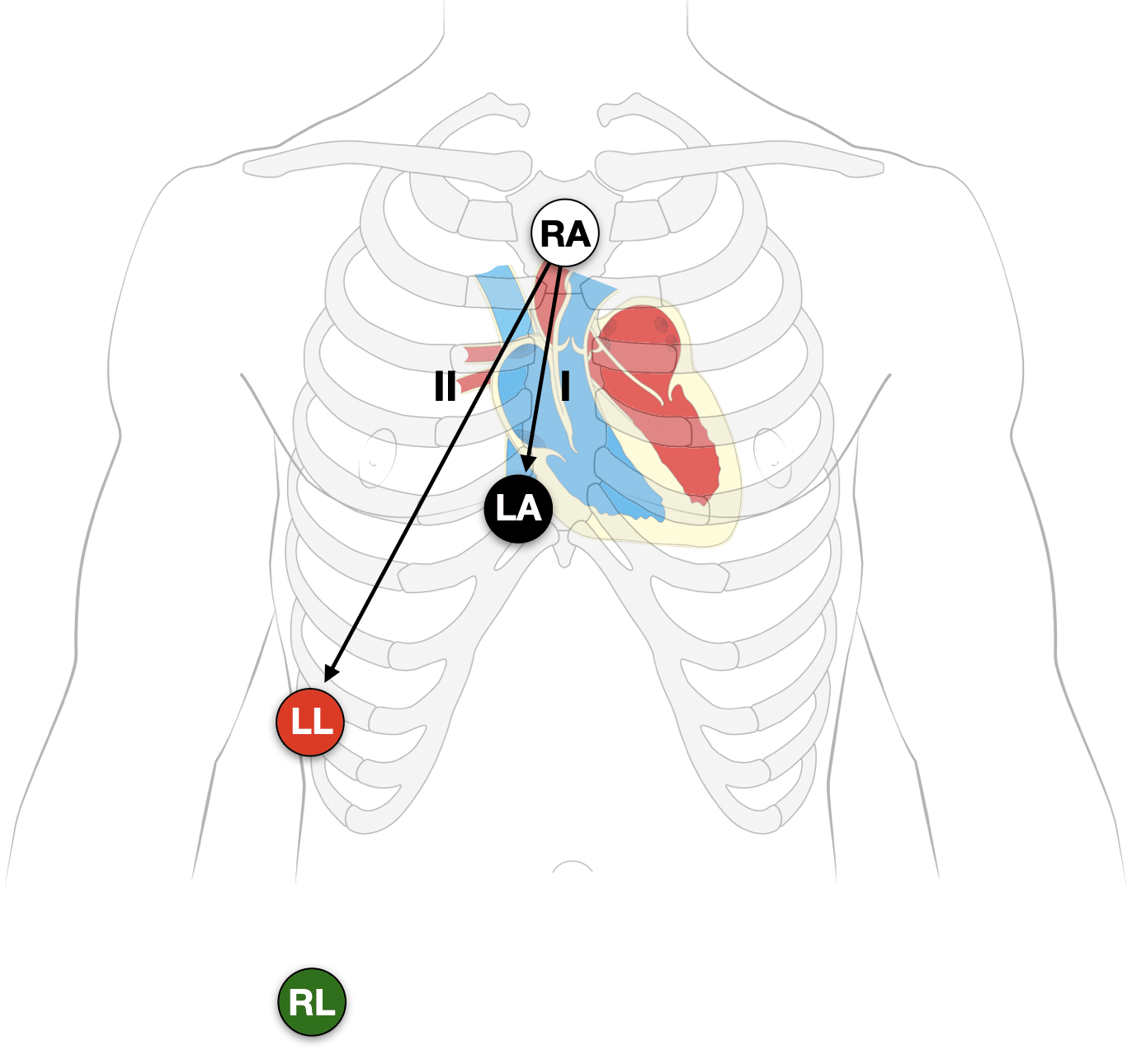 <p>A modified electrocardiogram (ECG) configuration designed specifically to amplify and better isolate atrial electrical activity.</p><p>To increase the amplitude of P waves or flutter waves, making them distinct from the much larger ventricular QRS</p>