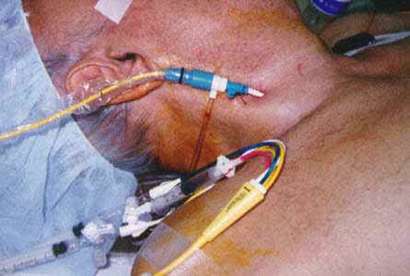 <p>-balloon flotation device inserted through the internal jugular vein or femoral vein into the pulmonary artery</p><p>-monitors blood flow and the function of the heart</p>
