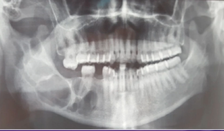 <p>all of the following are in the DDx EXCEPT: </p><p>odontogenic myxoma </p><p>ameloblastoma </p><p>dentigerous cyst </p><p>odontogenic keratocyst </p>