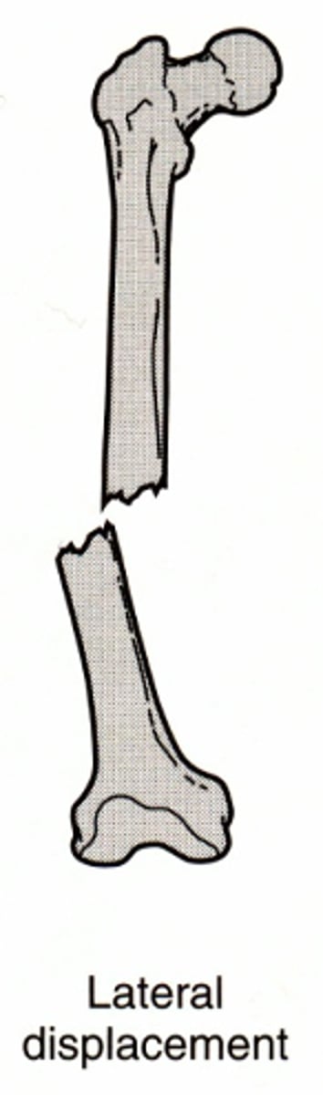 <p>describes movement of distal fragment relative to proximal</p>