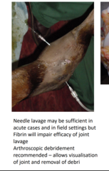 <p>Needle joint lavage</p><p>- 14G needles ingress + egress 1-3L Ringers</p><p>Arthroscopic lavage </p><p>Arthrotomy</p>