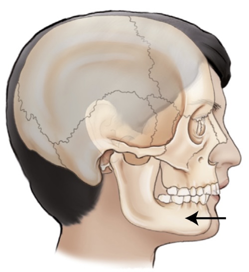 <p>what is the name of the movement where the jaw is moved backwards?</p>