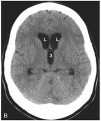 <p>ventricles are usually disproportionally dilated compared w the sulci</p>