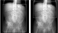 <p>Start location: 2 cm above kidneys End location: Just below symphysis pubis</p>
