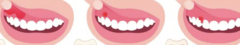 <p>Localized pus accumulation at base of periodontal pocket.</p>