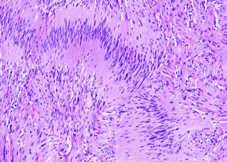 <ol><li><p>Sickle Cell Anemia</p></li><li><p>Atherosclerosis</p></li><li><p>Adenocarcinoma of Kidney</p></li><li><p>Osteogenic Sarcoma of Bone</p></li><li><p>Tattoo in Human Skin</p></li><li><p>Neurilemmoma</p></li><li><p>Anthracosis of the Lung</p></li><li><p>Basal Cell Carcinoma</p></li><li><p>Lung</p></li><li><p>Skeletal</p></li><li><p>Kidney</p></li><li><p>Neuron</p></li><li><p>Skin</p></li><li><p>Blood</p></li><li><p>Bone</p></li><li><p>Aorta</p></li></ol><p></p>