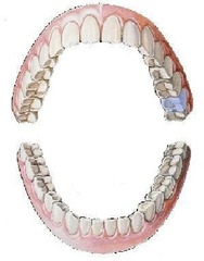 <p>maxillary left second molar</p>