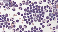 <p>What type of effusion is this?</p>