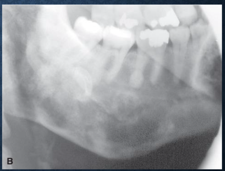 <p>superior displacement of the IAN is typically associated with…</p>