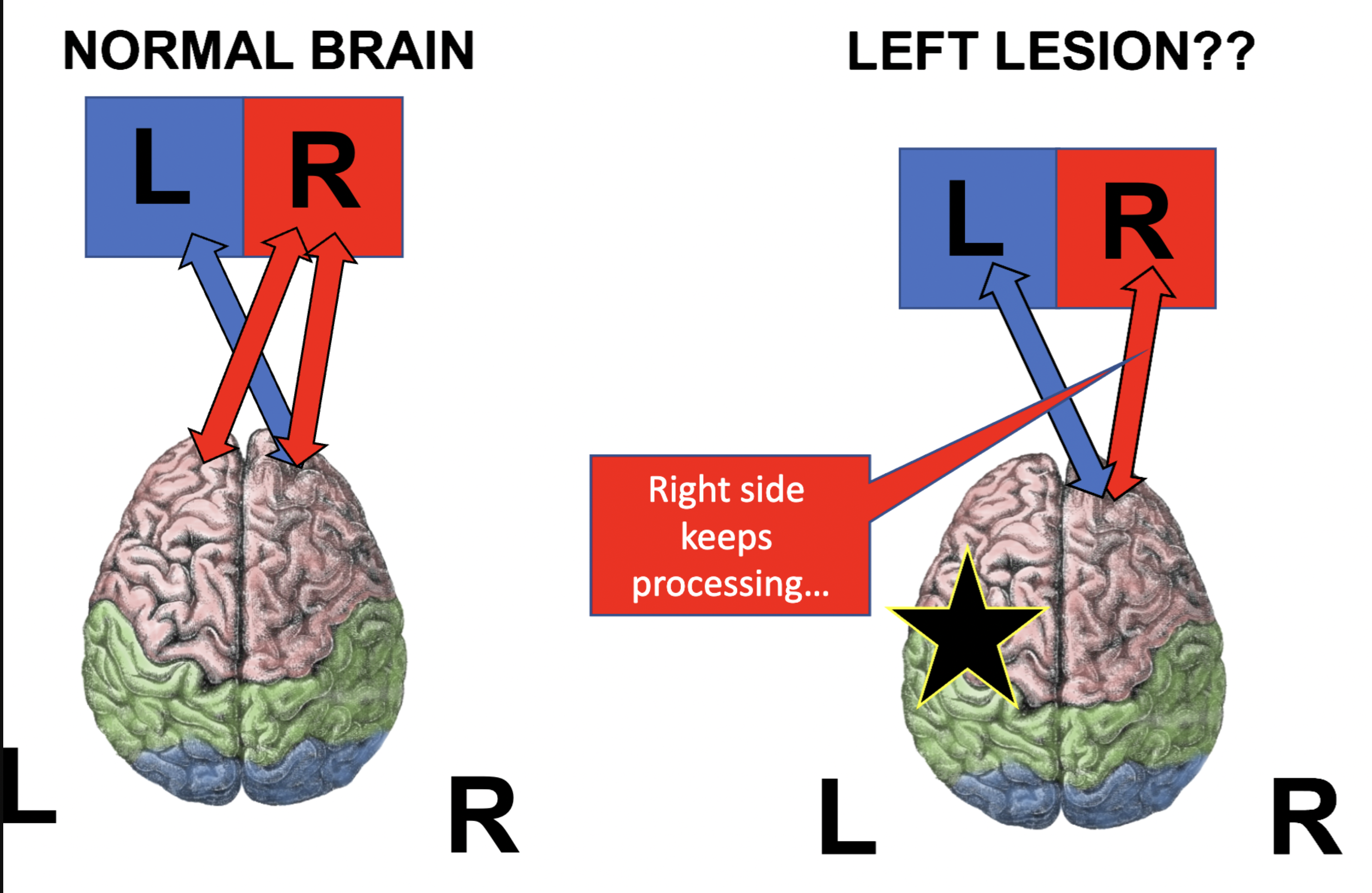 <p>Left neglect: Not paying attention to or being unaware of things on the left side of space.</p><p>Brain area: Usually caused by damage to the right parietal lobe.</p><p>Why more common than right neglect? The right hemisphere pays attention to both sides of space, while the left hemisphere mainly attends to the right side. So right-hemisphere damage can cause left neglect, but left-hemisphere damage is less likely to cause right neglect.</p>