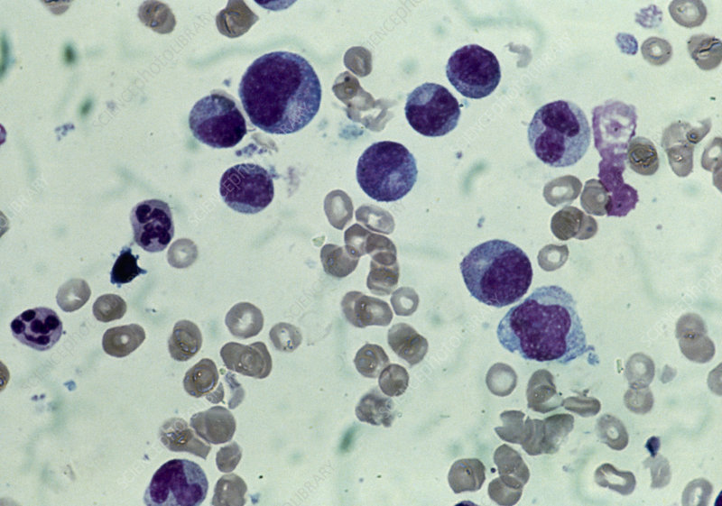 <p>BONE MARROW APLASIA OR PANCYTOPENIA</p>