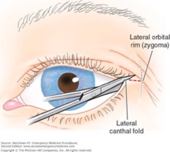 <p>Causes loss of vision:</p><p>- Compartment syndrome of the eye</p><p>- May require lateral canthotomy to decompress orbit</p>