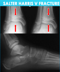 <p>Salter Harris V Fracture</p>