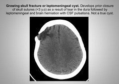 <p>Leptomeningeal cyst</p>