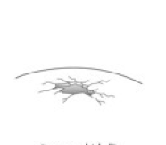 <p>Depressed Fracture</p>
