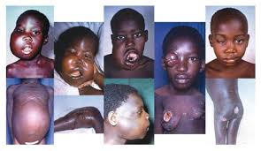<p><strong>Endemic (African) BL</strong></p><ul><li><p><strong>Childhood cancer common in equatorial Africa; </strong><span style="color: red;"><strong>Jaw tumors</strong></span></p></li><li><p>EBV found in 100% of cases</p></li><li><p><strong>Incidence higher in regions <u>in which malaria is hyperendemic</u></strong></p></li><li><p><strong>C- myc translocation </strong><span style="color: red;"><strong>leading to high expression of c-myc and high cell proliferation</strong></span></p></li></ul><ul><li><p><strong>Chemotherapy gives excellent results</strong></p></li></ul><p></p>