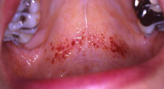 <p>minute hemorrhage (1-2 mm) in skin, mucosa, serosa; multiple red/ purple spots, do not blanch with pressure; due to injuries, accidents, excessive coughing, vomiting  </p>