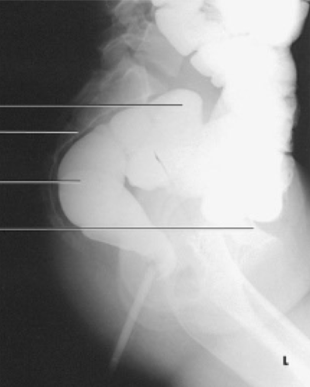 <p>Rectum and distal sigmoid</p><p>(decubitus shows A/F levels)</p>