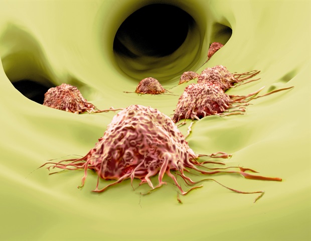 The spread of cancer cells from their original location to another part of the body.