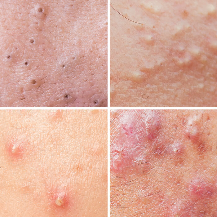 <p>What is acne vulgaris?</p>