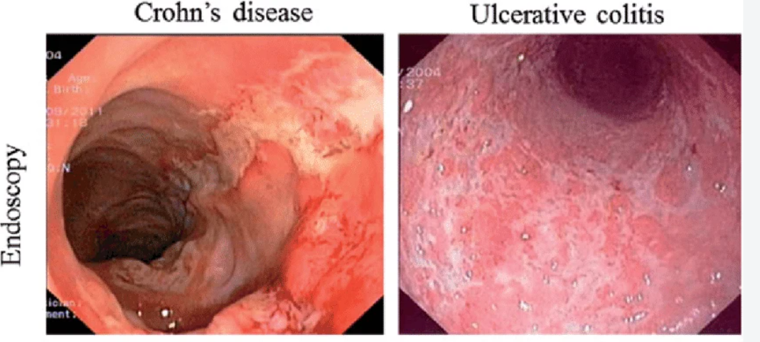 <p>Jawaban : </p><p>Keduanya ec. Autoimun, px utama dengan endoskopi.</p><ul><li><p><strong>Kolitis ulseratif : </strong>ascending dari rectum-colon proximal, klinis <u>ULCERS </u>→<strong> U</strong>lcer, <strong>L</strong>ead pipe sign, <strong>C</strong>ontinous lesion (difus-simetris), <strong>E</strong>xtend proximally, <strong>R</strong>ed diarrhea, <strong>S</strong>ubmucosa/mucosa inflammation</p></li><li><p><strong>Crohn disease : </strong>seluruh saluran cerna (mulut-anus), klinis <u>CHRISTMAS </u>→ <strong>C</strong>obble stone, <strong>H</strong>igh temperature (demam), <strong>R</strong>educed lumen,<strong> I</strong>ntestinal fistulae,<strong> S</strong>kip lesion, <strong>T</strong>ransmural inflammation, <strong>M</strong>alabsorption, <strong>A</strong>bdominal pain, <strong>S</strong>tring sign</p></li></ul><p></p>