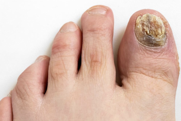 <p>caused by various dermatophytes, incidence increases with age </p><p>manifestations: affects toenails most often, may affect fingernails on one hand; brittle, thickened, broken, or crumbling nails with yellowish discoloration</p><p>management: oral/topical antifungals, podiatry consult, thinning of toenails or nail removal</p>
